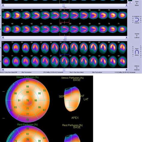 Myocardial Perfusion Spect Single Photon Emission Computed Tomography