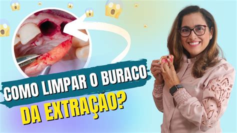 Como limpar o buraco da extração Adornare Odontologia Estética em