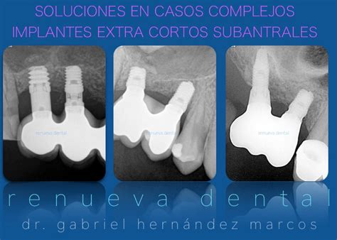 Implantes Dentales Cortos Y Extracortos