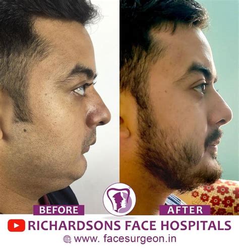 Genioplasty – Richardson's Plastic Surgery Hospitals