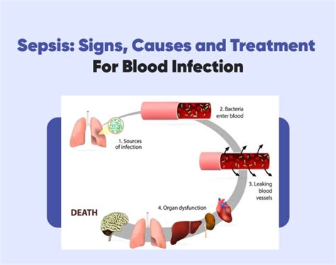 Can All Infections Cause Sepsis at Randall Barrow blog