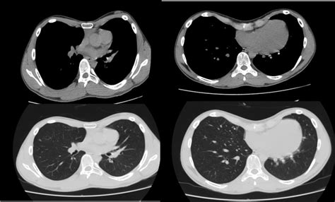 Figure At The Computerized Chest Scan Statpearls Ncbi Bookshelf