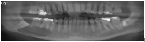 Keratocystic Odontogenic Tumor Kcot Of The Mandible