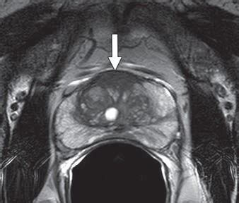 Prostate Cancer Mri Images