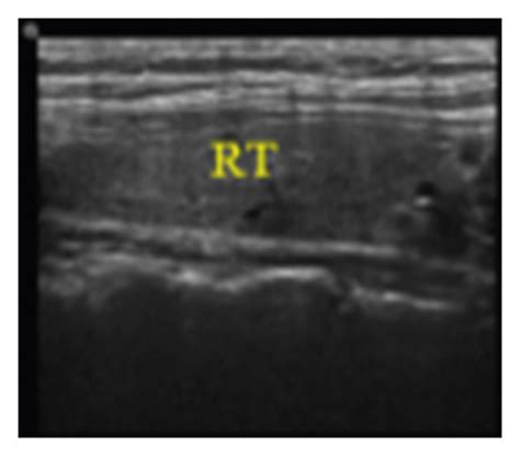 Thyroid Ultrasound Standard Plane Images Ti Represents Thyroid