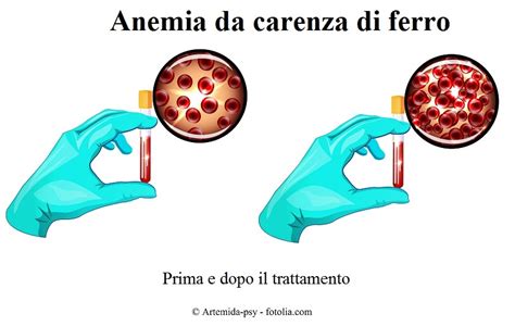 Anemia Da Carenza Di Ferro O Sideropenica Valori Sintomi Cause E Cura