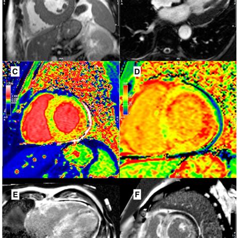 A Mid Ventricular Short Axis Cine BSSFP Image In Telediastole And B