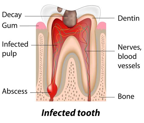 Abscessed Teeth Southlake Endodontics