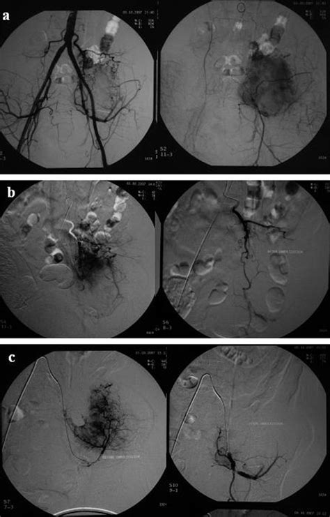 A Anteroposterior View Of Aortogram Demonstrates A Prominent Tumoral Download Scientific