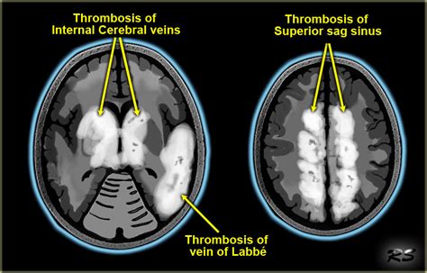 The Radiology Assistant Cerebral Venous Sinus Thrombosis