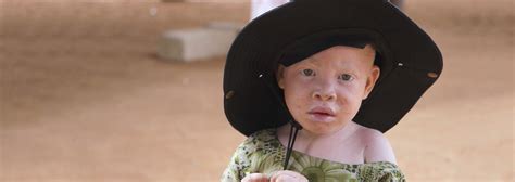 Albinos in Tanzania documentary — RTD