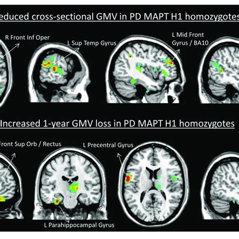 Cross Sectional Reduced Gray Matter Volume Top And Increased 1 Year