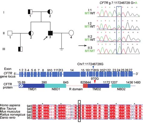 Identification Of Homozygous Cftr Mutation In The Patient With Cbavd