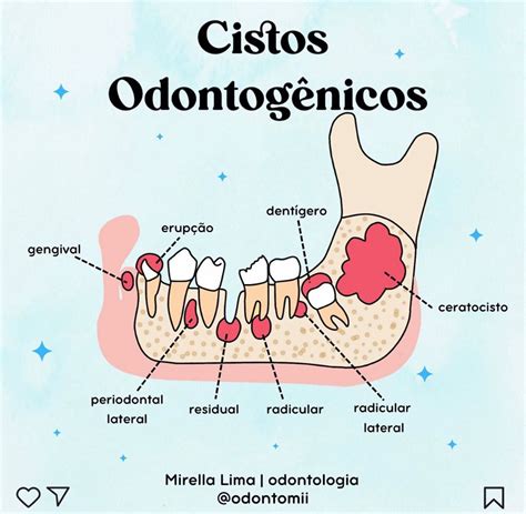 Cistos odontogênicos Odontologia Cirurgia bucal Auxiliar de saude bucal