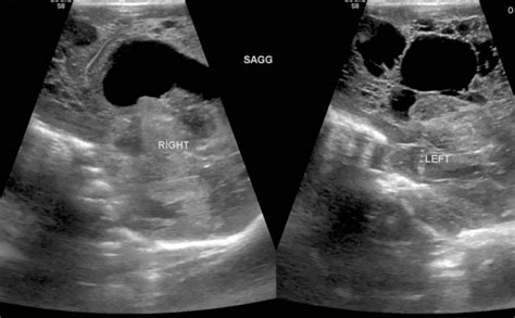 Grade Iv Germinal Matrix Hemorrhage With Periventricular Leukomalacia