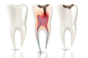 Caries Dental Causas Y Tratamientos Bis Salud