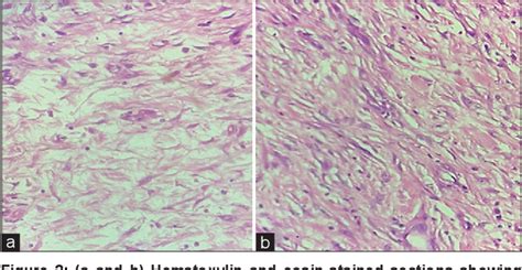 Figure 1 From Role Of Fibrotic Cancer Stroma In Rectal Carcinoma An