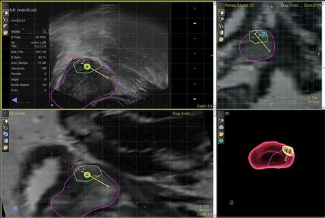 Fusion Biopsy Asui