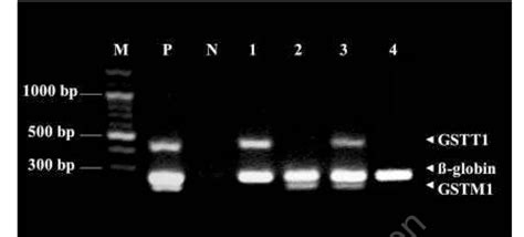 Multiplex Pcr For Gstt Gstm And Globin Using Genomic Dna