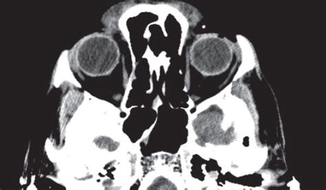 CT Scans Useful Prognostic Tool in Traumatic Eye Injury Patients