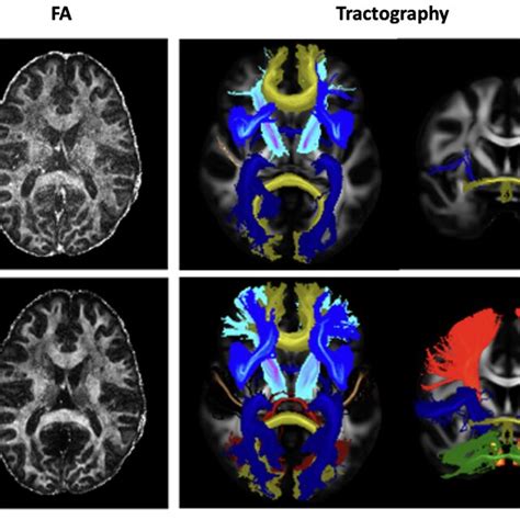 Examples Of Fa Maps Left And Maximum Intensity Projection Mip Of