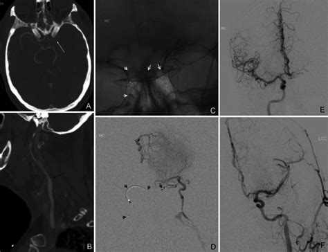 Case A Axial Ct Angiogram Of The Head Showing Acute Left M