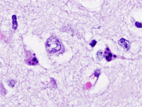 Clinical Neuro Path Cerebrovascular Disease Images Flashcards Quizlet