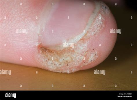 Warts On Thumb Of Child Stock Photo Alamy