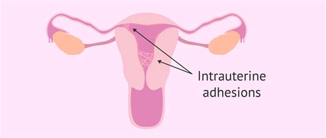 Pelvic Or Uterine Adhesions