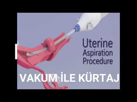 Vakum ile Kürtaj Nedir Dr Eser AĞAR YouTube