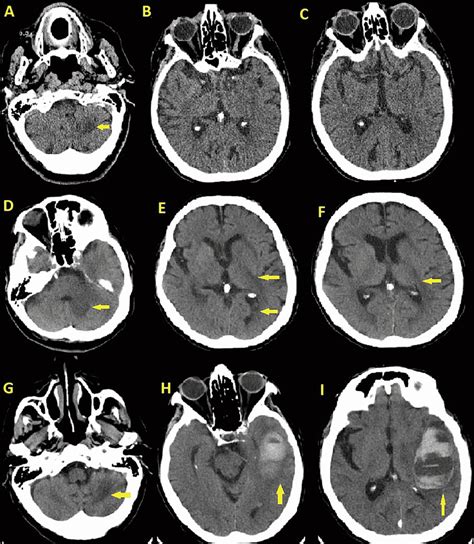 Computed Tomography Ct Scan Of The Brain Withwithout Contrast A C