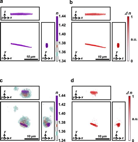 Birefringence Properties Of Patient Monosodium Urate Msu Crystals And