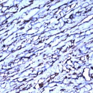 Immunostain Immunostaining Showing Spindle Myoepithelial Cells