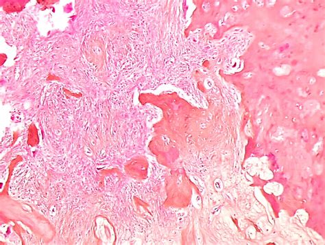 pathology outlines metaplasia
