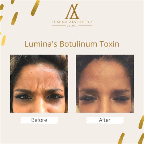 Anti Aging Treatment Lumina Aesthetics