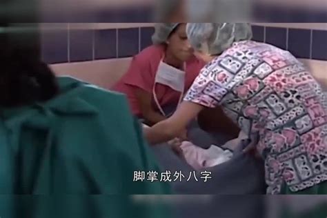 那个“美人鱼”女婴，出生时轰动众人，他现在过得怎么样了？轰动女婴众人