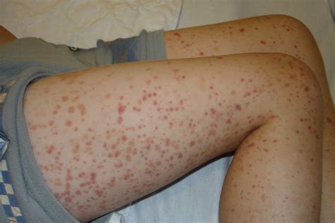 What Does It Mean If You Have A Purpura Rash