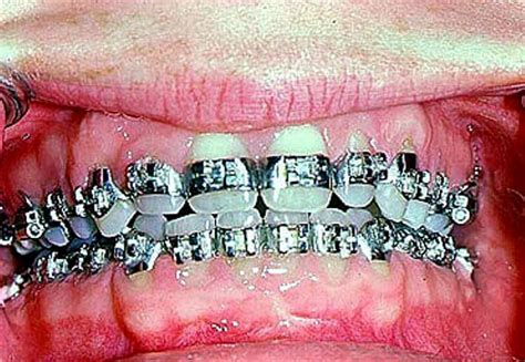 Fullybandedbraces Fullbands Dental Braces Straight Teeth