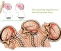 Traumatic Brain Injury Flashcards Quizlet