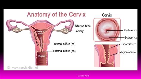 SOLUTION: Presentation and treatment of cervictis and cervical polyp ...