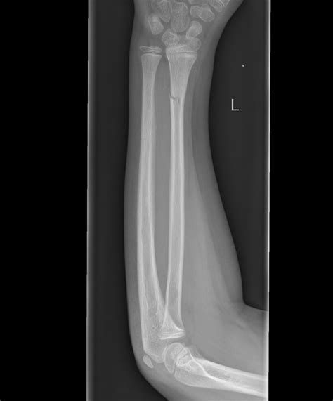 Greenstick Fracture Diagram