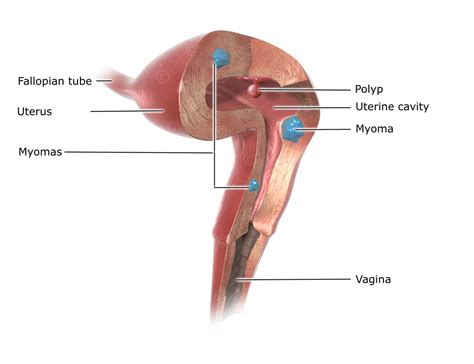 Illustration Polyp In Uterus Medicalgraphics