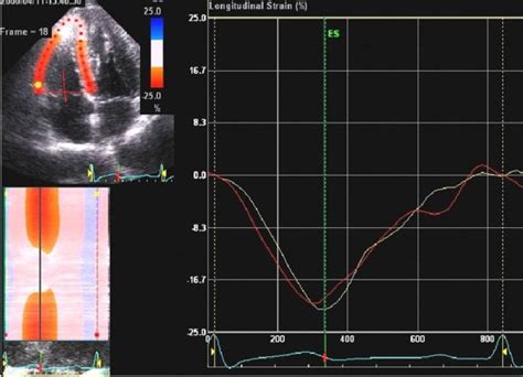 Longitudinal Myocardial Strain Using D Strain Imaging At The Base Of