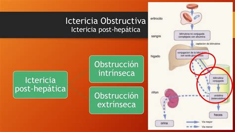 Ictericia obstructiva