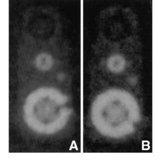 Radiographs Demonstrating The Codmanhakim Programmable Valve Implanted