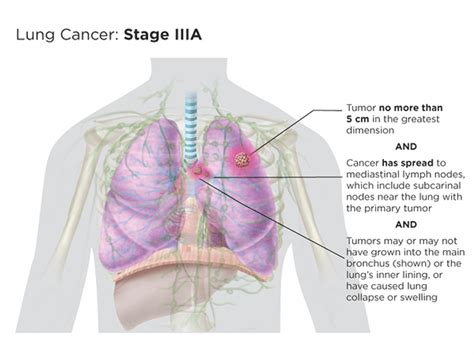 Lung Cancer Staging Lungevity Foundation