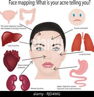 acne diagram   face