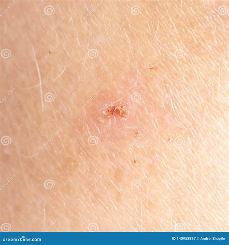 Wound On Human Skin As A Background Stock Image Image Of Blood Pain