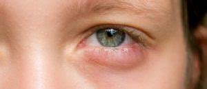 how to get rid of a swollen eye fast