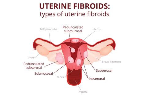 Learn About Fibroids And Polyps Pelvic Awareness Project